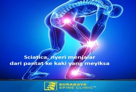  Sciatica , Pain Radiation from The Buttocks to The Feet